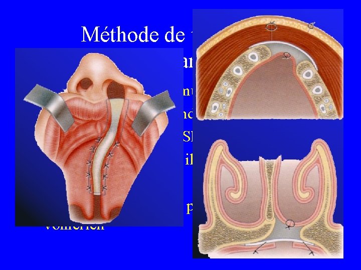 Méthode de traitement du palais antérieure • • • Migration de la fibromuqueuse Méthode