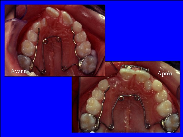 Traitement secondaire • Orthodontie en dentition mixte Avant • Ostéopériostoplastie gingivale et greffe osseuse