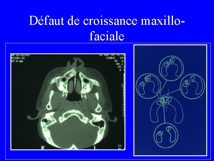 Défaut de croissance maxillofaciale • Hypoplasie maxillaire Fentes labiales = 267 Ostéotomies = 31