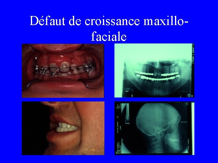 Défaut de croissance maxillofaciale 