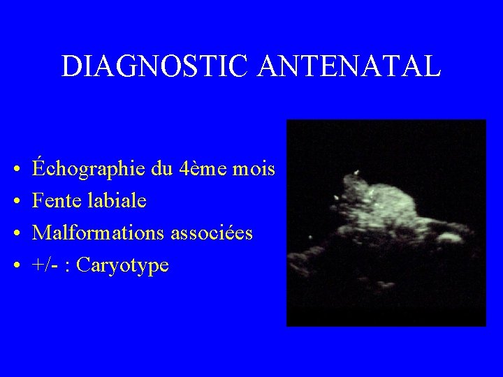 DIAGNOSTIC ANTENATAL • • Échographie du 4ème mois Fente labiale Malformations associées +/- :