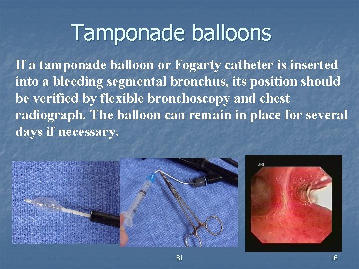 Tamponade balloons If a tamponade balloon or Fogarty catheter is inserted into a bleeding