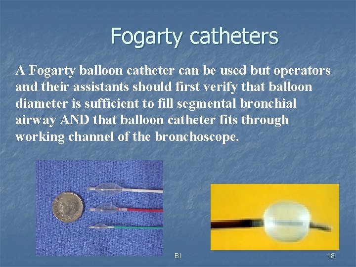 Fogarty catheters A Fogarty balloon catheter can be used but operators and their assistants