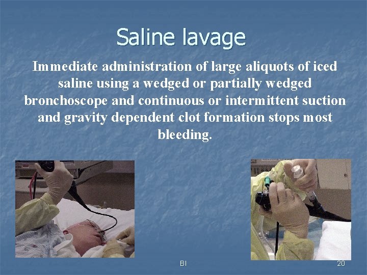 Saline lavage Immediate administration of large aliquots of iced saline using a wedged or