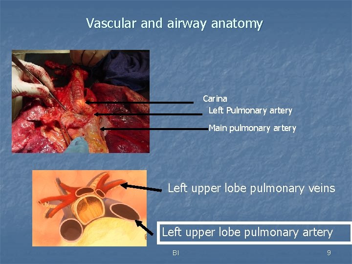 Vascular and airway anatomy Carina Left Pulmonary artery Main pulmonary artery Left upper lobe