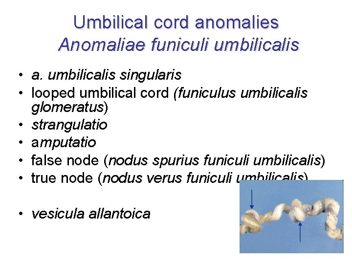 Umbilical cord anomalies Anomaliae funiculi umbilicalis • a. umbilicalis singularis • looped umbilical cord