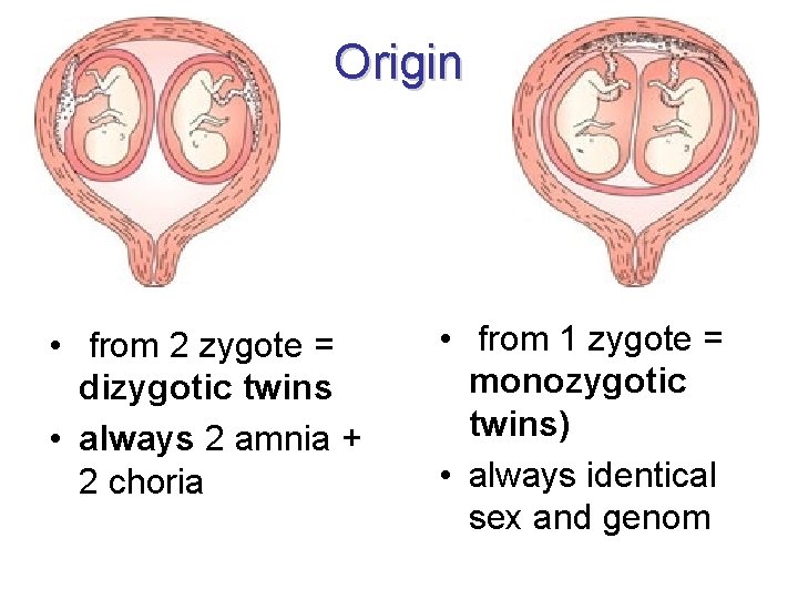 Origin • from 2 zygote = dizygotic twins • always 2 amnia + 2