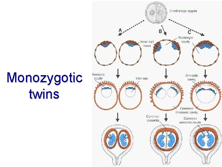 Monozygotic twins 