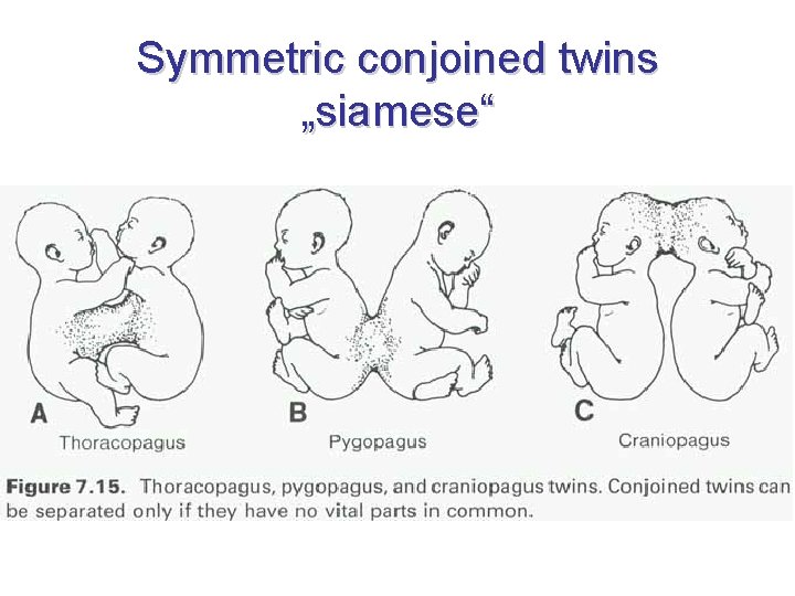 Symmetric conjoined twins „siamese“ 