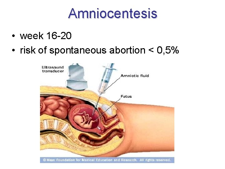 Amniocentesis • week 16 -20 • risk of spontaneous abortion < 0, 5% 