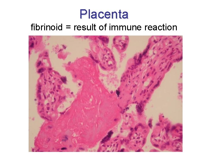 Placenta fibrinoid = result of immune reaction 