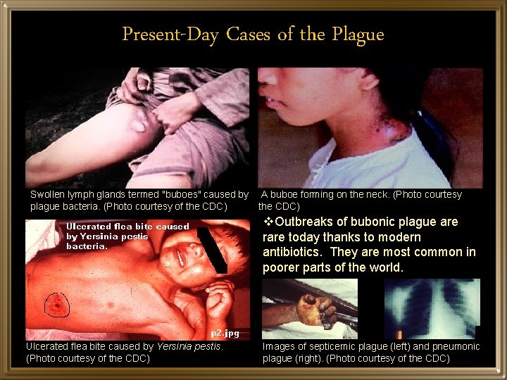 Present-Day Cases of the Plague Swollen lymph glands termed "buboes" caused by A buboe