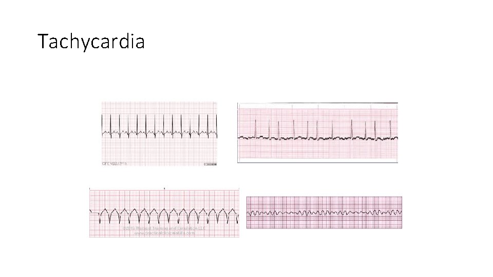 Tachycardia 