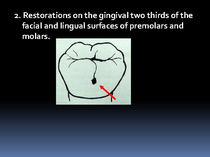 2. Restorations on the gingival two thirds of the facial and lingual surfaces of