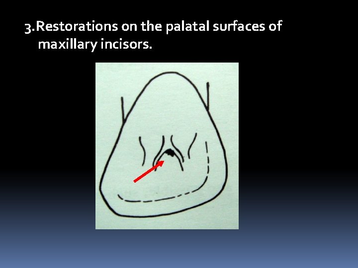 3. Restorations on the palatal surfaces of maxillary incisors. 