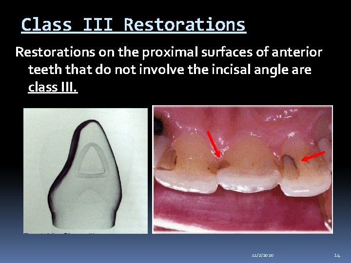 Class III Restorations on the proximal surfaces of anterior teeth that do not involve