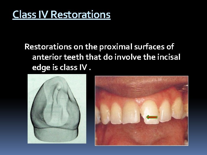 Class IV Restorations on the proximal surfaces of anterior teeth that do involve the