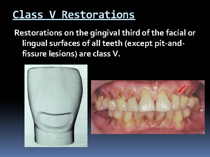 Class V Restorations on the gingival third of the facial or lingual surfaces of