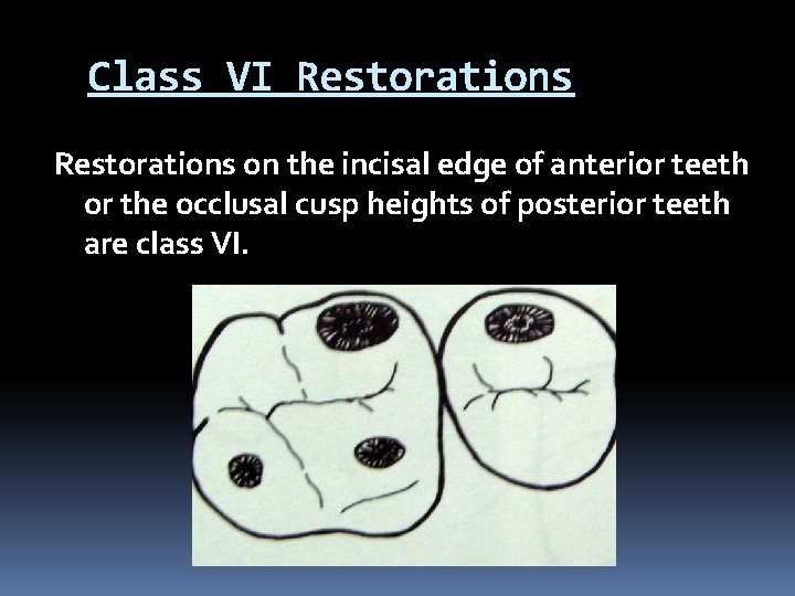 Class VI Restorations on the incisal edge of anterior teeth or the occlusal cusp