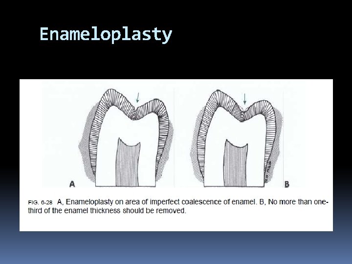 Enameloplasty 