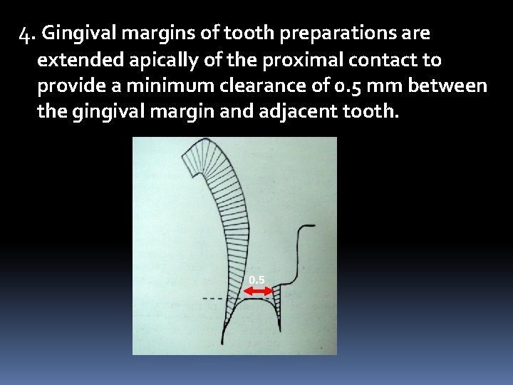 4. Gingival margins of tooth preparations are extended apically of the proximal contact to