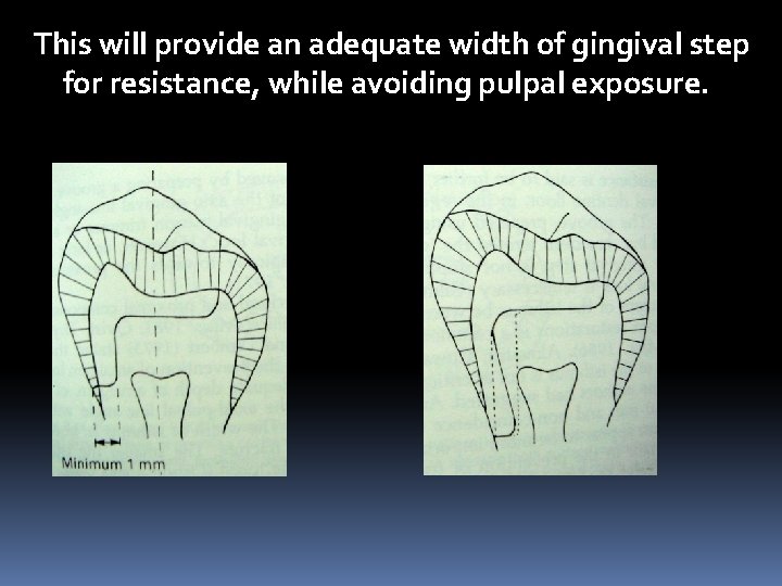 This will provide an adequate width of gingival step for resistance, while avoiding pulpal