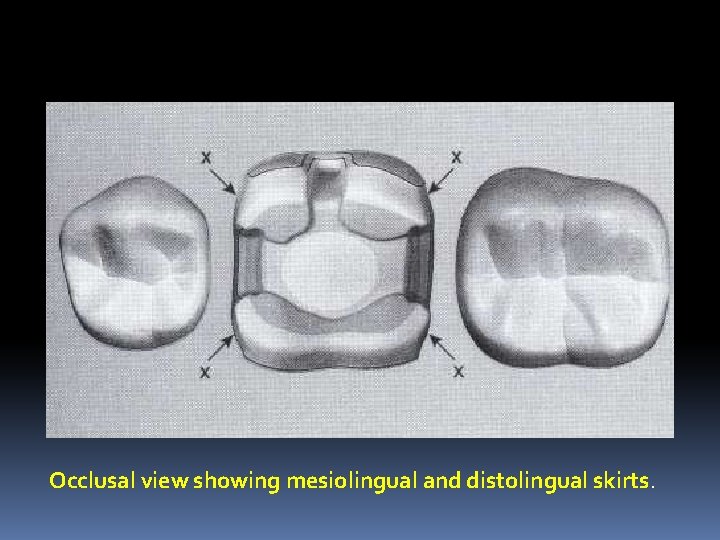 Occlusal view showing mesiolingual and distolingual skirts. 