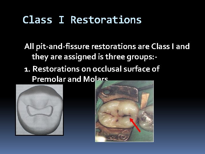 Class I Restorations All pit-and-fissure restorations are Class I and they are assigned is