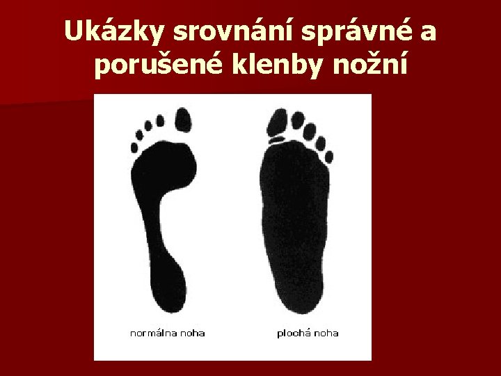 Ukázky srovnání správné a porušené klenby nožní 