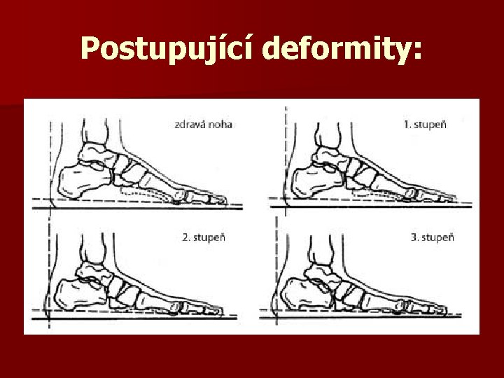 Postupující deformity: 