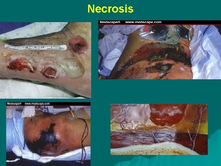 Necrosis 