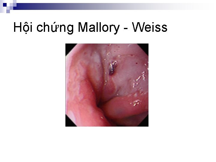 Hội chứng Mallory - Weiss 