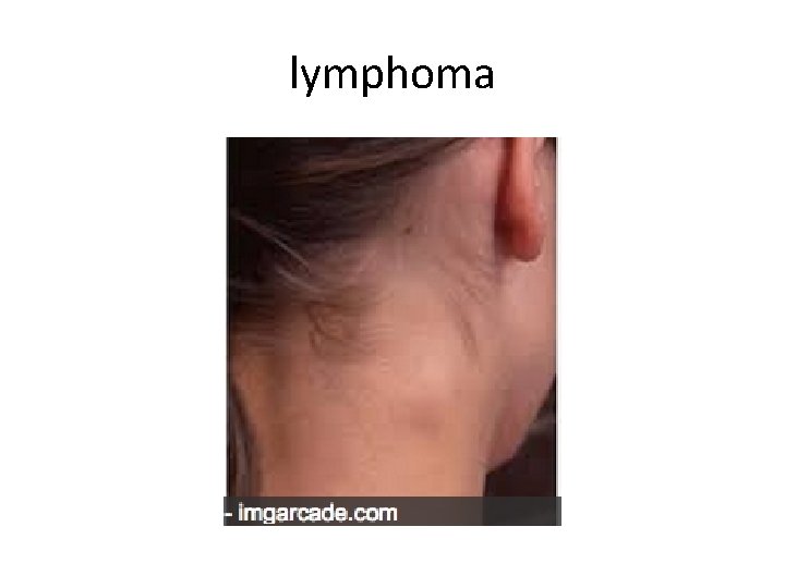 lymphoma 