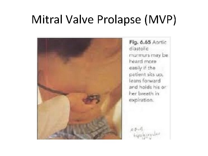 Mitral Valve Prolapse (MVP) 