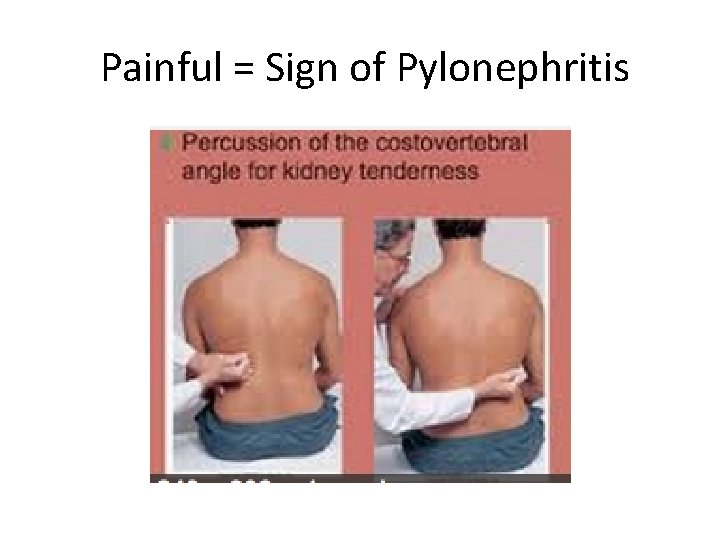Painful = Sign of Pylonephritis 