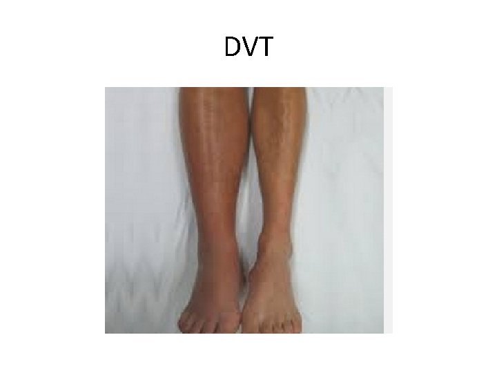 DVT 