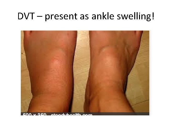 DVT – present as ankle swelling! 