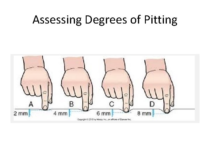 Assessing Degrees of Pitting 