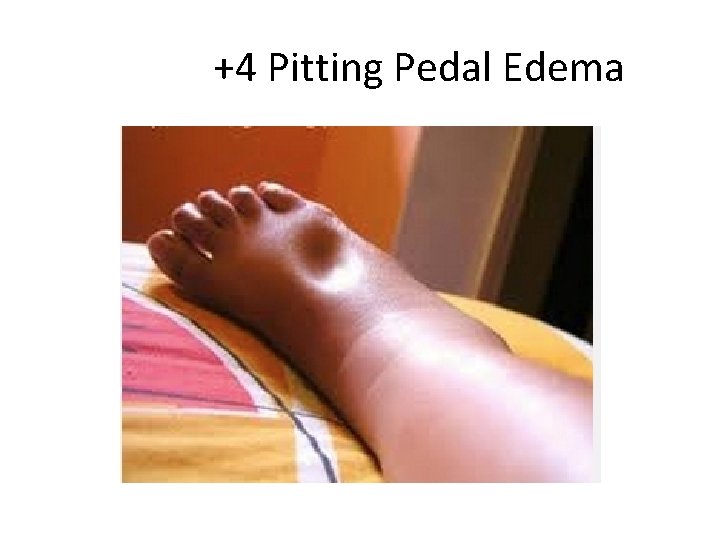 +4 Pitting Pedal Edema 