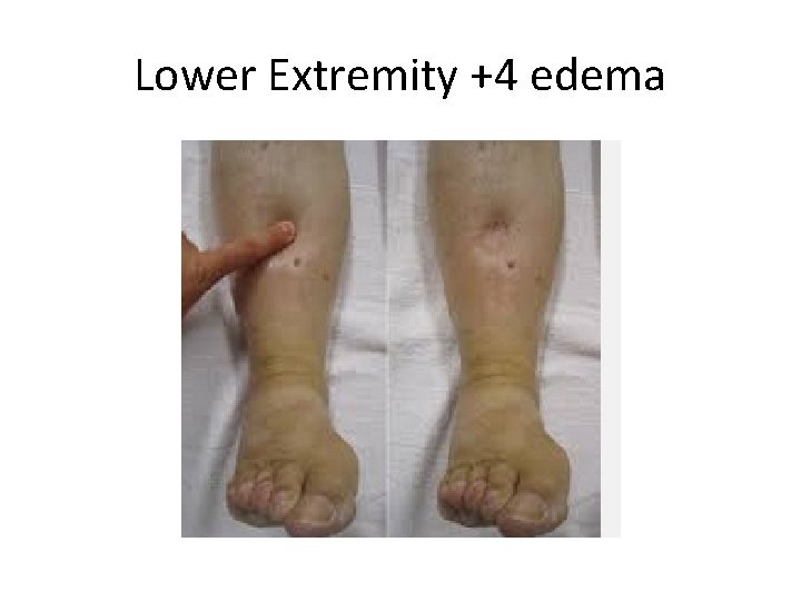 Lower Extremity +4 edema 