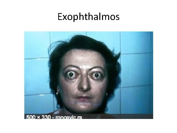 Exophthalmos 
