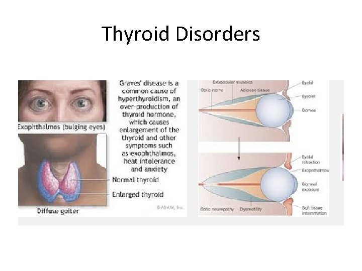 Thyroid Disorders 