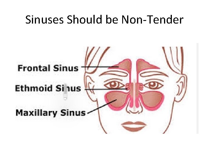 Sinuses Should be Non-Tender 
