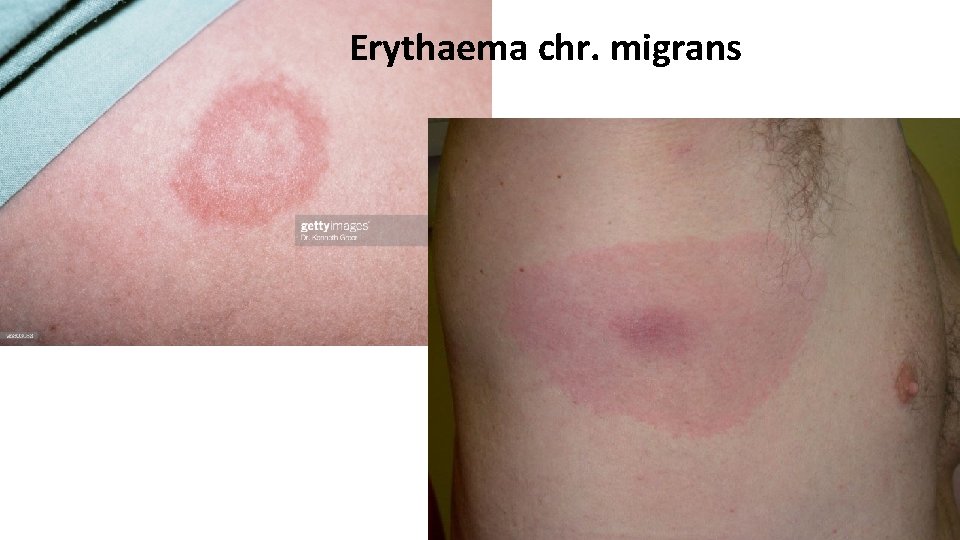 Erythaema chr. migrans 