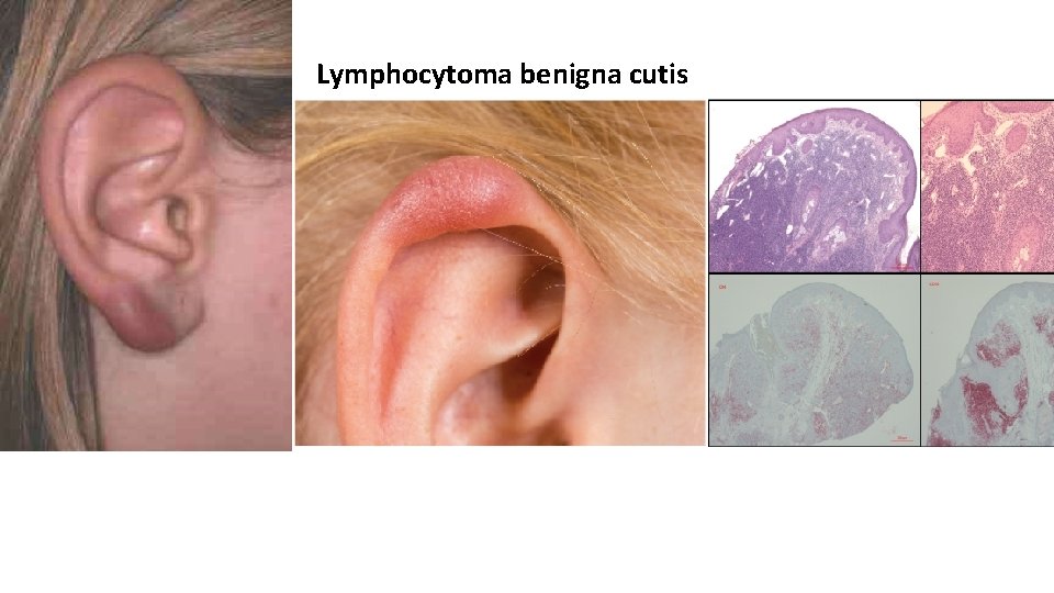 Lymphocytoma benigna cutis 