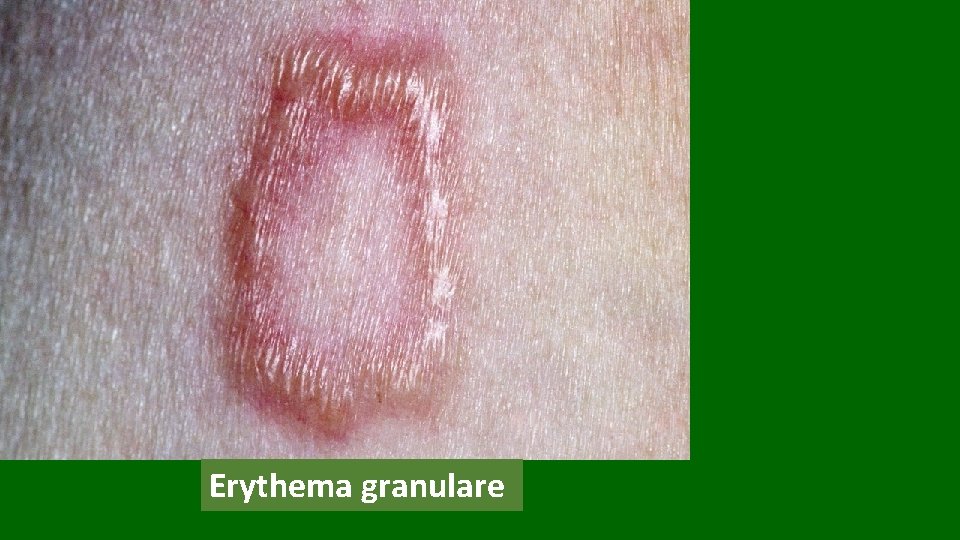 Erythema granulare 