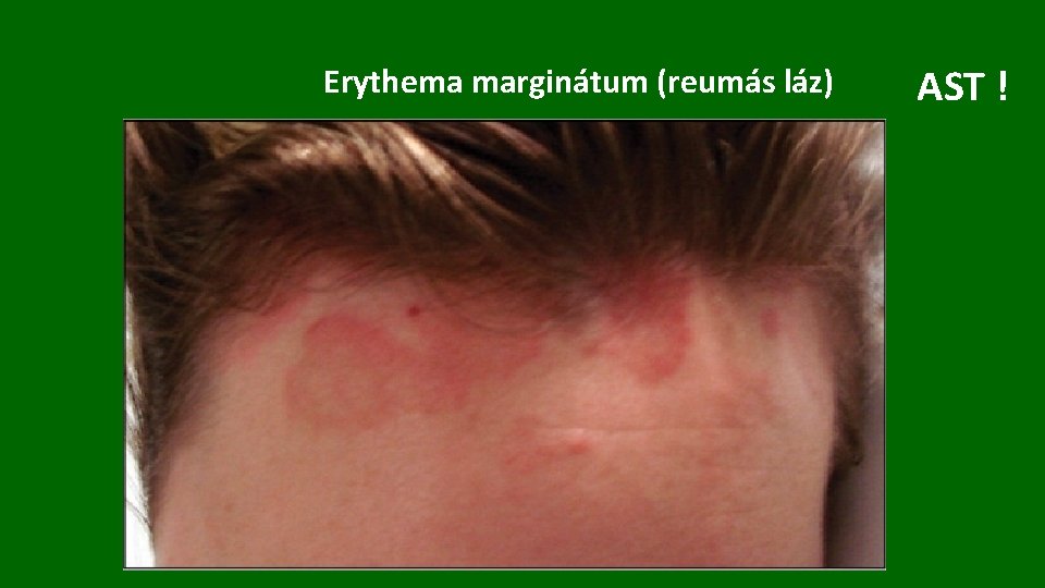 Erythema marginátum (reumás láz) AST ! 