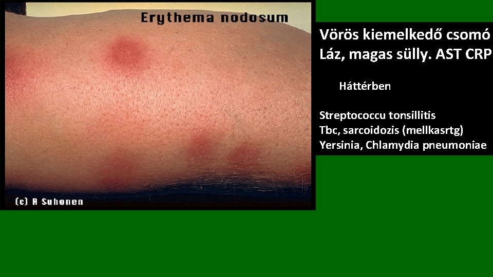 Vörös kiemelkedő csomó Láz, magas sülly. AST CRP Háttérben Streptococcu tonsillitis Tbc, sarcoidozis (mellkasrtg)