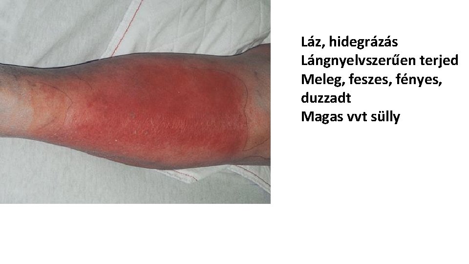 Láz, hidegrázás Lángnyelvszerűen terjed Meleg, feszes, fényes, duzzadt Magas vvt sülly 