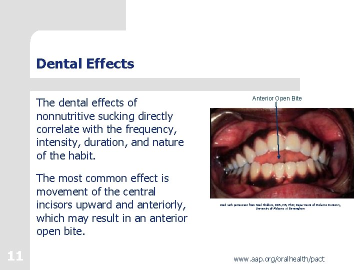 Dental Effects The dental effects of nonnutritive sucking directly correlate with the frequency, intensity,